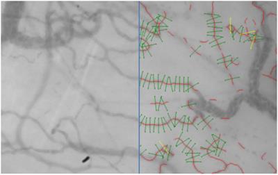 Multimodal measurement of glycocalyx degradation during coronary artery bypass grafting